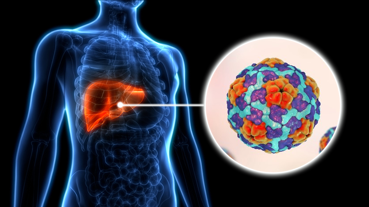 Image Hepatitis A