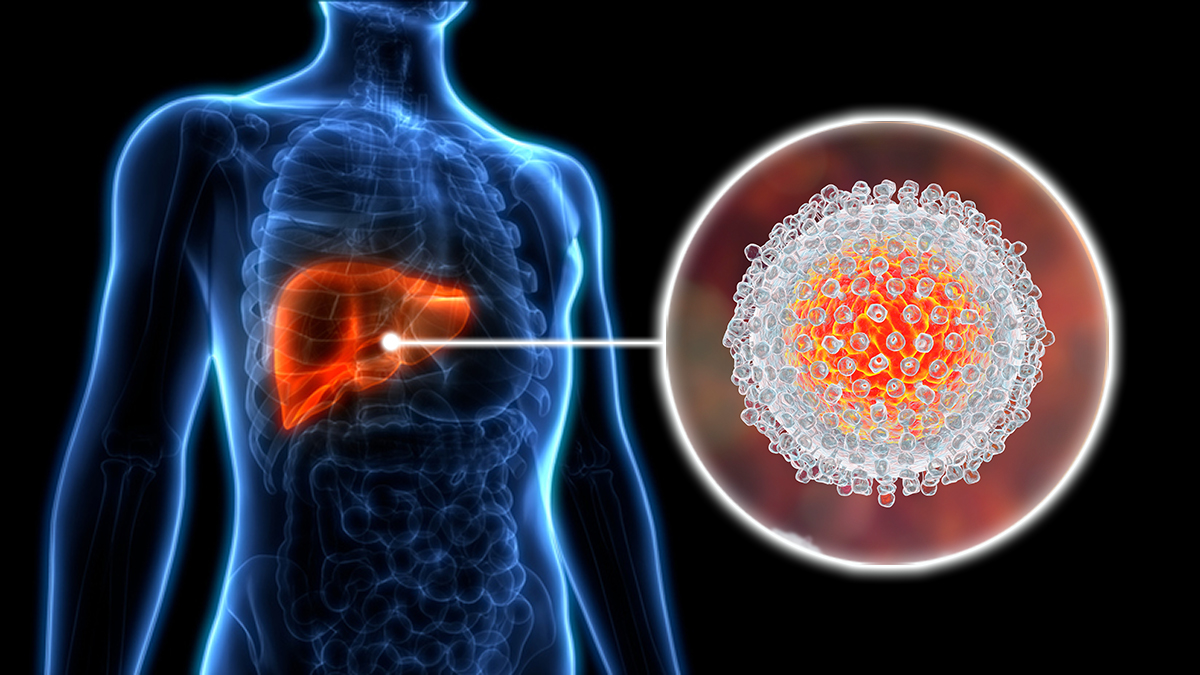  What is Hepatitis C